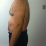 Before-Passive-Extension-Treatment