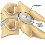 degenerative-disc-disease-vancouver